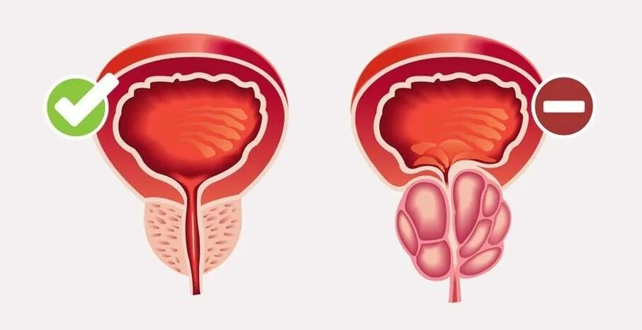 Prostatitis férfiakban
