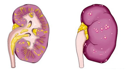 Mi az akut prosztatitisz vezet