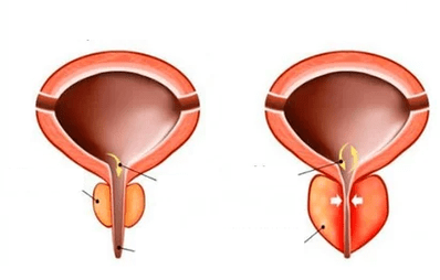 Mi az akut prosztatitisz